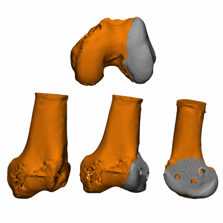 Recinstruccion hemicondilar con implante a la medida (1)