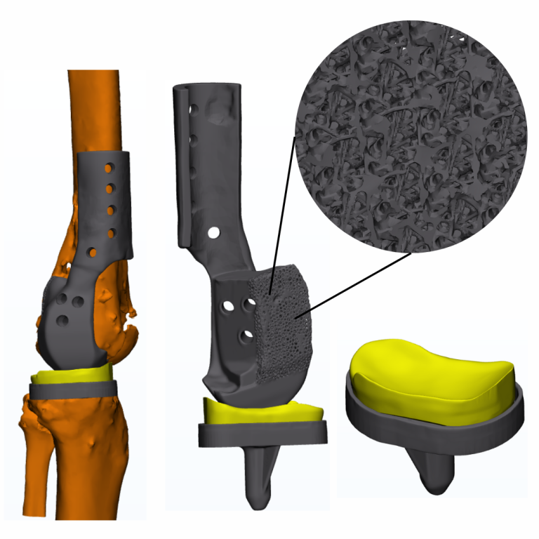 Recinstruccion hemicondilar con implante a la medida (2) (1)