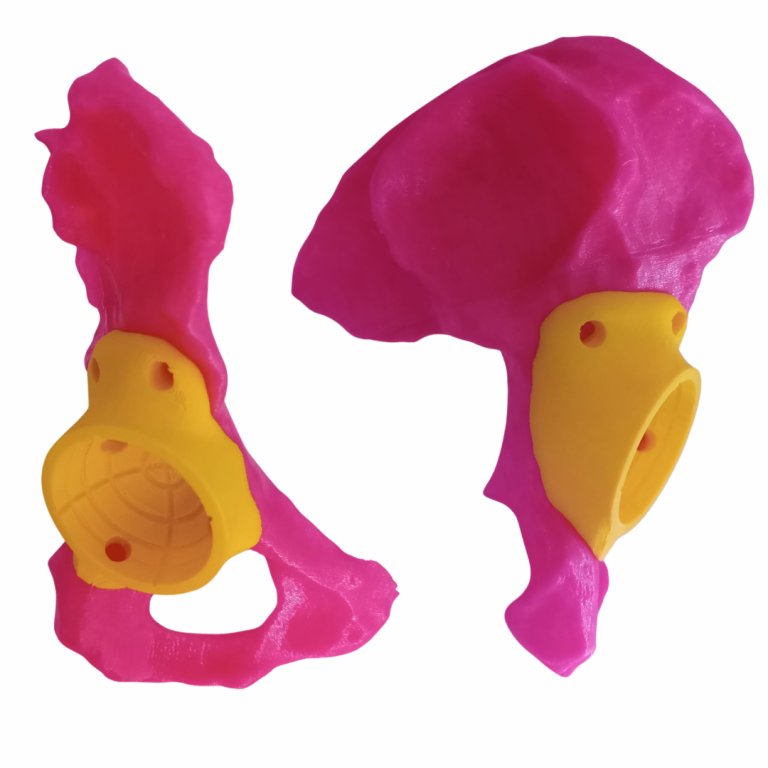 Recinstruccion hemicondilar con implante a la medida (5) (1)