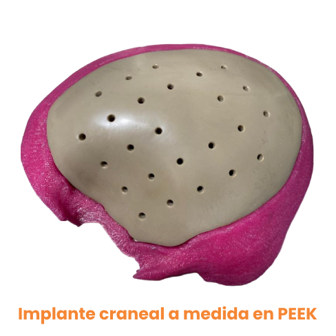 implante craneal 1