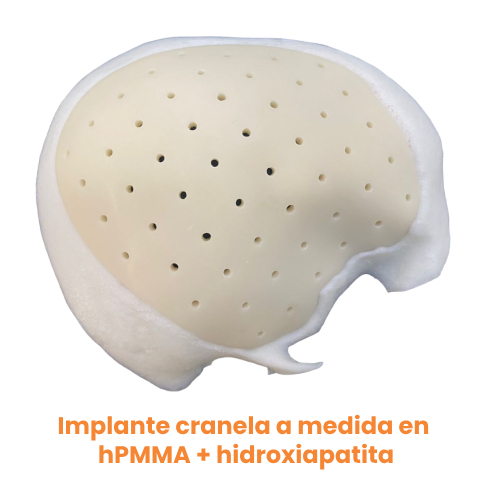 implante cranela a medida en hPMMA + hidroxiapatita